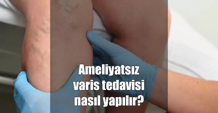 ameliyatsız varis tedavisi nasıl yapılır