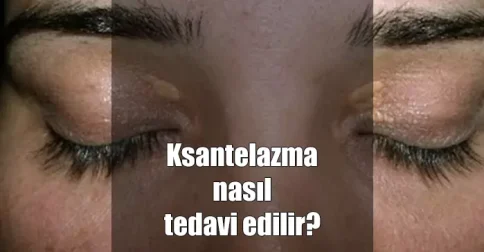 ksantelazma tedavisi nasıl yapılır