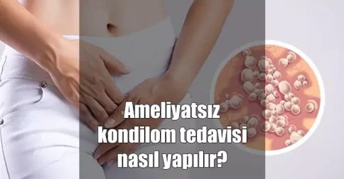 ameliyatsız kondilom tedavisi nasıl yapılır