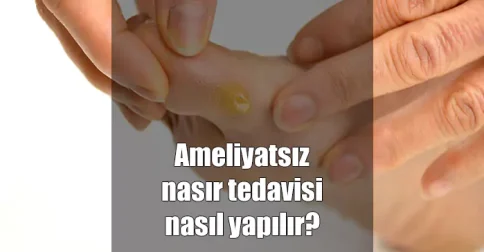 ameliyatsız nasır tedavisi nasıl yapılır