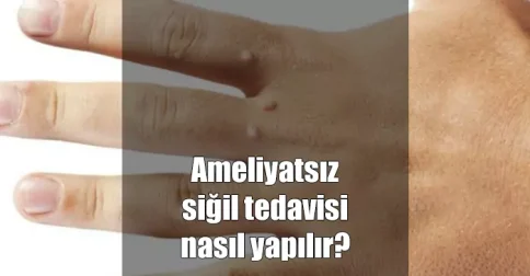 ameliyatsız siğil tedavisi