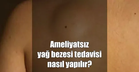 ameliyatsız yağ bezesi tedavisi