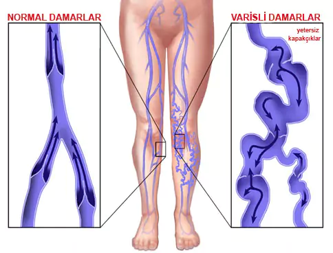 bacaklarda varis neden olur