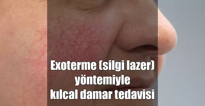 exoterme silgi lazer yöntemiyle kılcal damar tedavisi