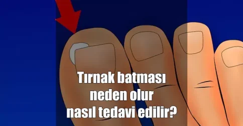 tırnak batması neden olur tedavisi nasıl yapılır